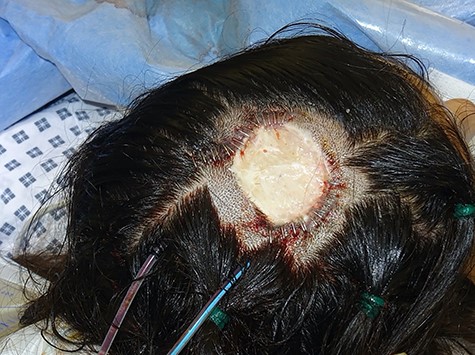 Intraoperative photograph taken following tissue expander insertion- rectangular expanders were inserted using a remote incision lateral to the midscalp defect; double-layered closure was used with the assistance of a malleable retractor for deep dermal closure followed by skin staples, closed system suction drains were sited adjacent to the leading edge of each expansion flap.