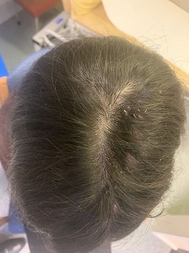 Final aesthetic result obtained 1 month after tissue expander removal.