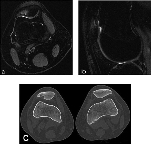 Radiographs of the patient’s knee at 14 years old (a) Axial T2-weighted MRI sequences (b) sagital T2-weighted MRI sequences showed abnormality area at the superolateral facet of the patella in the deep subchondral area, this area of altered signal, hypointense in T1 and hyperintense in T2 with a shaded surrounding edema, was oval in morphology and had a craniocaudal extension of about 12 mm and transversal about 10 mm, the lesion interrupted the corresponding patellar articular cartilage which appears swollen in this position (c) axial computed tomography scan showed loss bone at that same point of patella in the right knee.