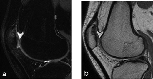 Radiographs after 2 years at 16 years old (a) sagital T2-weighted MRI sequences (b) sagital T1-weighted MRI sequences showed the area was still the same at the superolateral facet of the patella in the deep subchondral area.