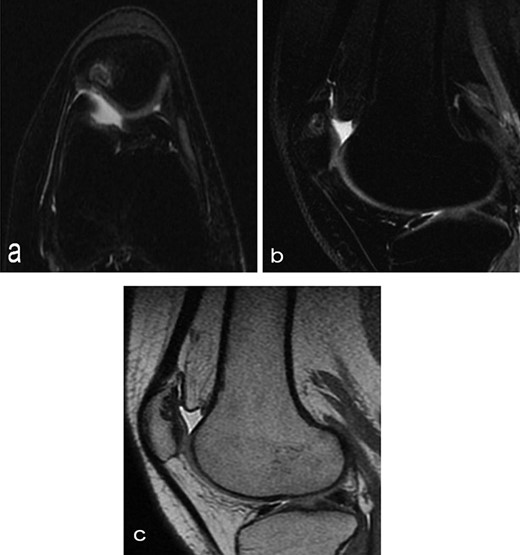 Six months after MSC treatment in (a) axial and (b) sagital T2-weighted of MRI T2 sequences the OCD in patella showed that area of cartilage in regeneration and fill of high water content suggestive of immature cartilage or fibrocartilage morphology (c) same lesion in sagital T1 weighted MRI sequences.