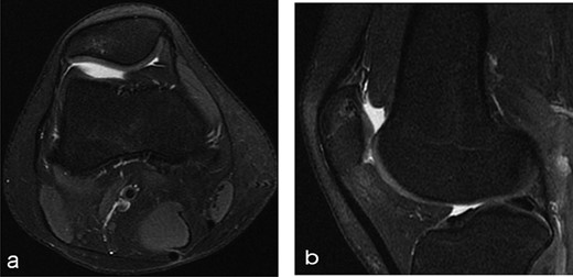 Twelve months after MSC treatment in (a) axial and (b) sagital T2-weighted of MRI T2 sequences the OCD in patella showed that area was almost regenerated with good fibrocartilage morphology.