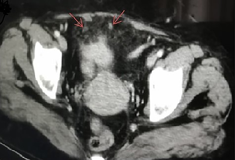 CT scan of abdomen and pelvis axial view showing intra-abdominal gallstones.