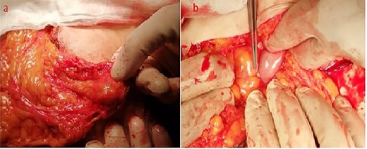 Intraoperative appearance of the spilled gallstones (a, b).