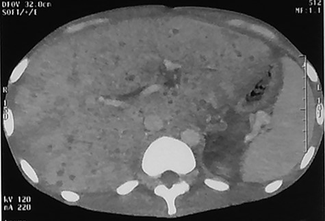Abdominal CT injected at portal phase performed on 10th postoperative day showing millimetric, homogeneous hypodensities disseminated in the hepatic parenchyma.