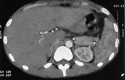 Abdominal CT scan (arterial phase) performed at 90th day after the beginning of the antibiotherapy showing normal liver parenchyma.