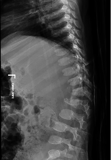 spine radiograph showing a compression fracture at T12 and L1, resulting in gibbus deformity.