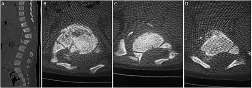 (A) sagittal thoracolumbar CT scan. (B–D) Axial thoracolumbar CT scan. (A-D) There are compression fractures and decreased vertebral body height of T12 and L1 with left pedicle and spinous process fractures. These fractures are associated with bony fragments within the spinal canal causing narrowing of the spinal canal at the same level. There is a nondisplaced fracture at the spinous process of L3 and the left transverse process of T10.
