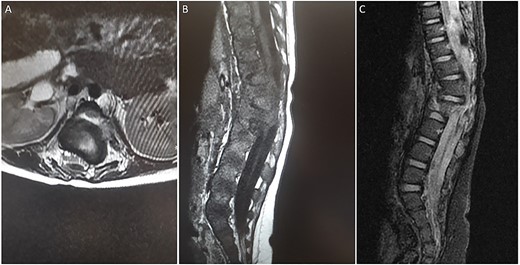 (A) axial T2-weighted MRI. (B) Sagittal T1-weighted MRI (C) Sagittal STIR MRI. (A-C) There are multiple fractures involving the lower thoracic and upper lumbar spine with involvement of the posterior columns and narrowing of the spinal canal. There is a large extramedullary lesion likely representing a small subdural hematoma.