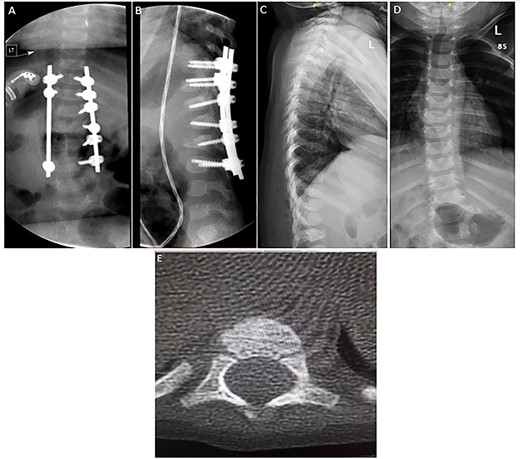 (A–B) Spine radiograph demonstrating bilateral paraspinal rods spanning from the level of T10 to L3 transfixed with pedicular screws. The screws and rods are in situ with signs of healed fracture. (C–D) Interval removal of the hardware transfixing the compression fractures of the lower thoracic and upper lumbar vertebrae. (E) Axial CT scan 7 months postoperatively confirming fusion.