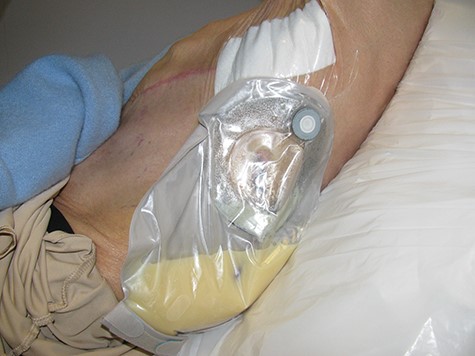 Stoma bag half full with chyle.