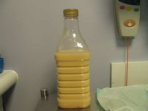 Chyle leak in a day collected in a bottle.