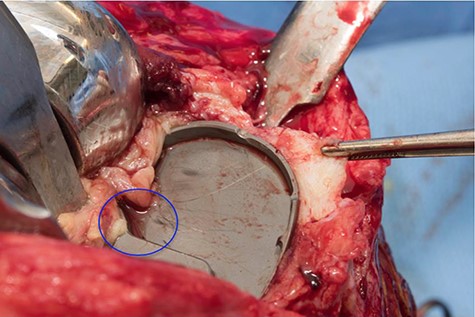 Intraoperative photograph showing the presence of biofilm on the tibial component (blue circle), note the presence of retracted fibrous tissue.