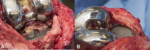 (a) Fibrous tissue growth in the posterior aspect of the right knee joint, (b) fibrous tissue growth in the anteromedial aspect of the right knee joint.