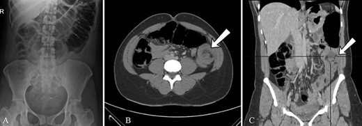 Radiological findings, (A)AXR, gaseous distention of the colon as far as mid-descending colon (B) CT, large bowel obstruction with transient point in the mid-descending colon secondary to large bowel intussusception.