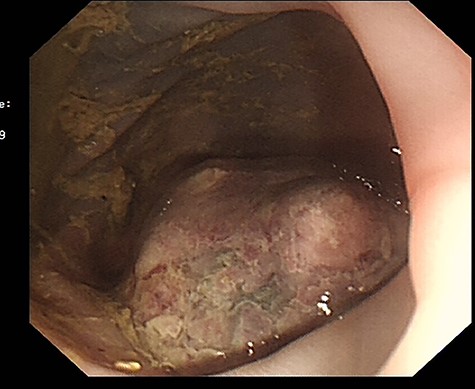 Submucosal Lipoma located in the mid-descending colon.