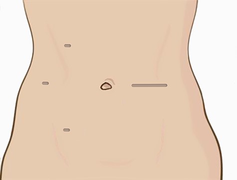 Port sites and extraction incision.