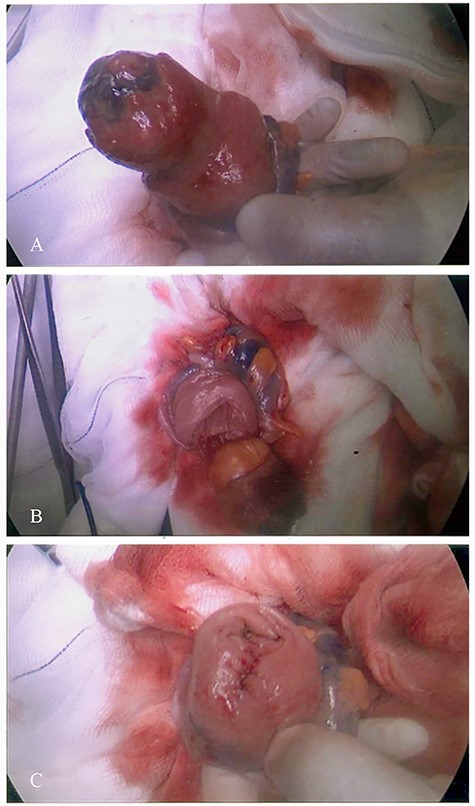 Surgical procedure demonstrating submucosal excision; (A): lipoma delivered through a colotomy, (B): submucosal excision and (C): closure of the mucosal defect.