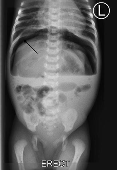 Plain abdominal X-ray shows free air under right dome of diaphragm (arrow).