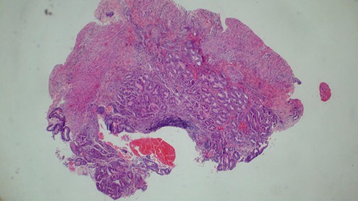 Histopathology of the biopsy from the gastric perforation showing near full thickness with non-specific mixed chronic inflammation (H&E staining, x10).