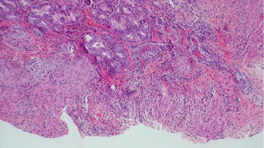 Histological appearance of gastric wall showing ulceration, mild chronic inflammation, focal hemorrhage and serosal fibrosis (H&E staining, ×20).
