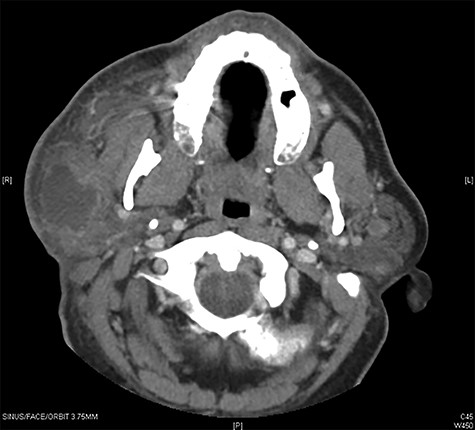 Maxillofacial Axial CT with contrast in the area of clinical interest demonstrating a 4 × 4.4 × 2 cm (AP, vertical transverse) well-circumscribed lesion in the right parotid superficial gland.