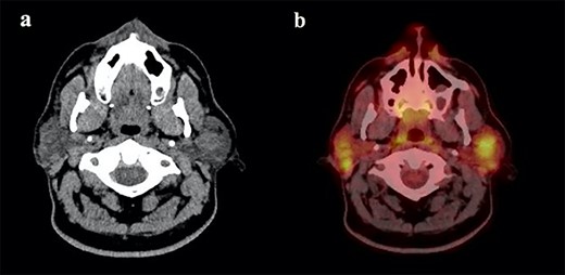 (a) Maxillofacial Axial CT with contrast showing multiple bilateral parotid gland lesions demonstrating internal enhancing septations with the largest lesion located in right parotid tail, measuring 1.9 x 2.1 cm and (b) associated PET CT scan showing bilateral hypermetabolic parotid lesions measuring up to a maximum standardized uptake value (SUV) of 10.0 on the left and 9.0 on the right.