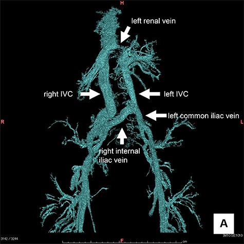 3D CT angiography: The left IVC was formed by the merger of the bilateral internal iliac and the left external iliac veins, which then merged with the left renal vein, and flowed into the right IVC.