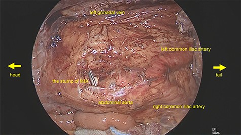 Intraoperative image: The left IVC was not visualized because the pre-hypogastric nerve fascia was preserved.
