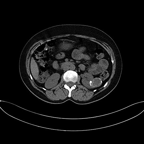 CT imaging revealing the 3-cm left renal cystic mass.