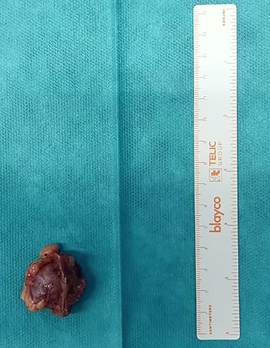 Macroscopic view of the cystic lesion specimen.