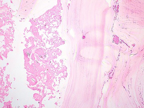 Pathological examination revealed presence of a laminated; acellular and eosinophilic membrane with presence of many scolexes in the cystic lumen. (HE; 100X).