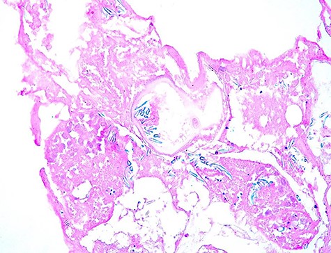 The scolexes showed presence of many hooklets that appeared refractile at microscopic examination (HE; 400X).