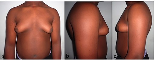 a–c. Simon’s Grade IIb gynaecomastia in an 11-year-old child.