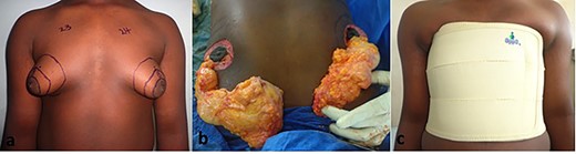 Preoperative markings (a), intraoperative excision of breast tissue (a), post-operative compression dressing (a).