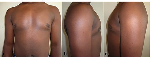 a–c. One-year post-concentric mastopexy for pubertal gynaecomastia.