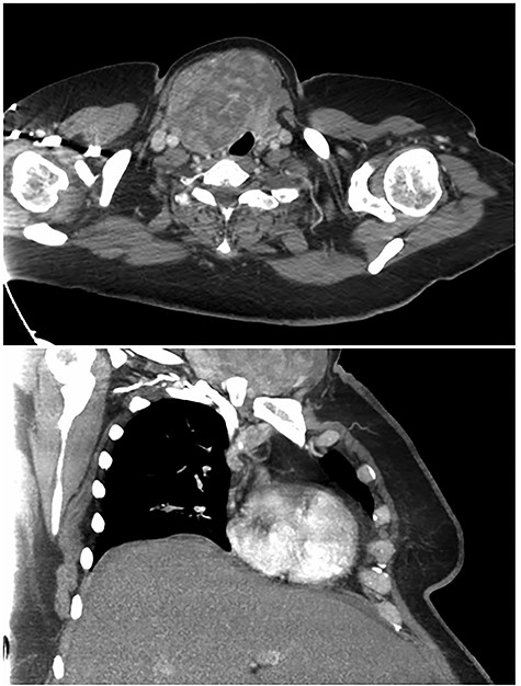 Preoperative computed tomography images highlighting large right thyroid nodule with tracheal compression.