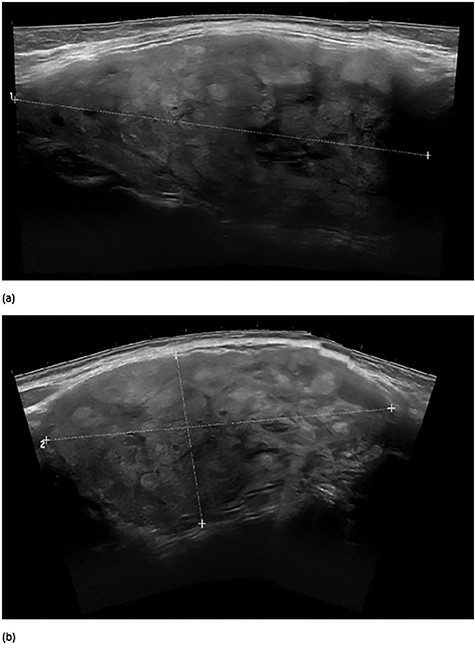 Preoperative surgeon performed right thyroid ultrasound images in longitudinal axis (a) and in transverse view (b). The large nodule measured 8.9 × 5.0 × 9.7 cm.
