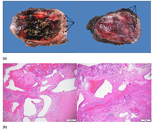 (a) Right thyroid gland with enlarged vessels (arrows) and hemorrhagic parenchyma on gross examination. (b) Large arterial and venous structures with background adenomatous and degenerative changes in the thyroid on microscopic examination.