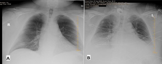 Chest X-ray (CXR) on the day of admission (A) versus Day 3 of admission (B). Initially relatively unremarkable except for minimal blunting of the left costophrenic angle. On Day 3—obtained due to increased PEEP—CXR revealed new bibasilar lung opacities suspicious for COVID-19 pneumonia.