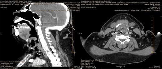CT of the head/neck on the day of admission, sagittal and axial views. Imaging reveals a nearly complete airway obstruction with thumb sign (seen on the left) due to marked epiglottic enlargement and without tonsillar enlargement or abscesses.