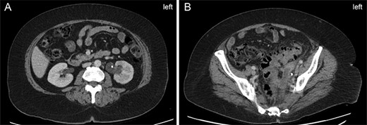 Left-sided hydronephrosis 6 months prior to presentation. (A) Left-sided hydronephrosis demonstrated at renal hilum with ureteric stent in place. (B) Demonstration of extensive diverticuli and surrounding inflammatory changes in the same CT scan as Panel A. Uretic stent is again seen.
