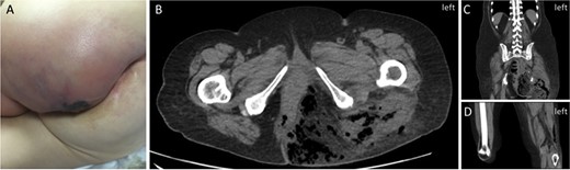 Initial patient presentation. (A) Initial presentation of left buttock on physical exam. (B) CT scan (axial view) demonstrating free air in left buttock. (C) CT scan (coronal view) demonstrating free air in the left thigh. (D) CT scan (coronal view) demonstrating free air extending into left popliteal fossa.