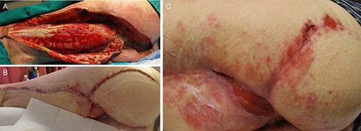 Photographs of the clinical course of the wound. (A) Left buttock and thigh 16 days after initial debridement. (B) Left buttock and thigh after delayed closure and rotational flap 2 months after initial surgery. (C) Development of pyoderma gangrenosum particularly noticeable over the left hip 6 months after surgery.