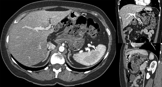 Computed tomography showed an internal hernia of the colon in the lesser sac, going back from the liver pedicle.