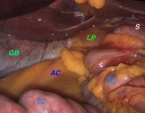 Laparoscopic exploration confirmed that the ascending colon and the right colonic flexure had herniated through the foramen of Winslow. Legend: AC: ascending colon, GB: gallbladder, LP: liver pedicle, S: stomach, TC: transverse colon.