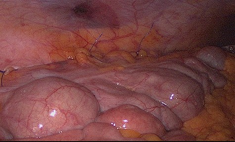 Fixation to the lateral wall of the ascending colon with several non-absorbable sutures.