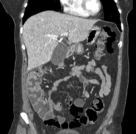 Postoperative computed tomography (coronal section) showed a good result of the right colon fixation on the lateral wall.