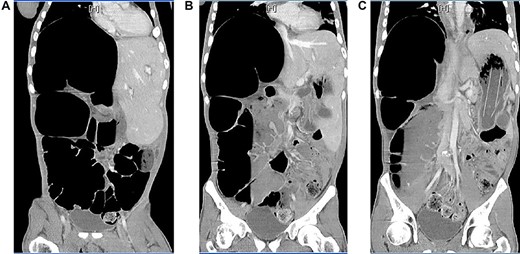 Axial view of CT of abdomen and pelvis with intravenous contrast (A) & (B), dilated cecum and colonic loop in the right upper quadrant and (C) foreign body within the stomach.