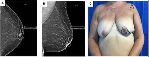 (A) cranio-caudal view (CC) mammogram showing speculated retroareolar mass. (B) Latero-medial oblique (LMO) view mammogram showing speculated retroareolar mass. (C) Preoperative image of left breast, note retracted nipple.